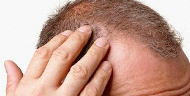 Saç Dökülmesi Nasıl Önlenir?
